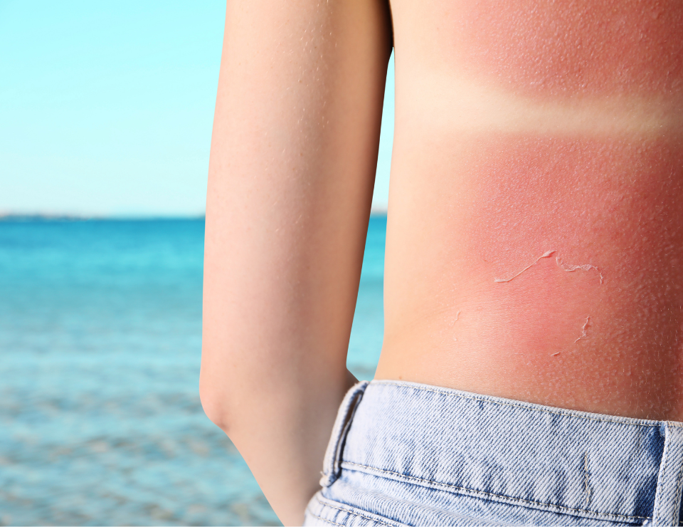 Coup de soleil : comment apaiser sa peau naturellement ?